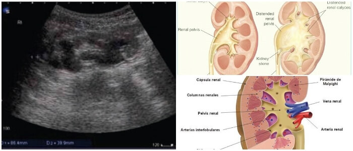 What Is Ectasis In Medical Terms