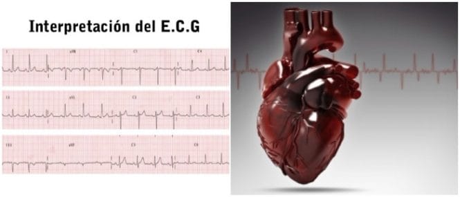 electrocardiograma interpretacion