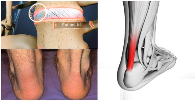 Definición de entesitis