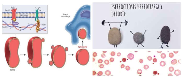definición de esferocitosis