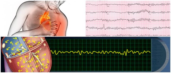 Definción de fibrilacion ventricular