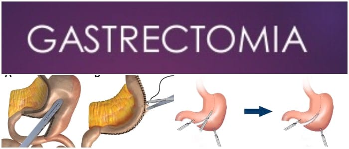 gastrectomia atipica
