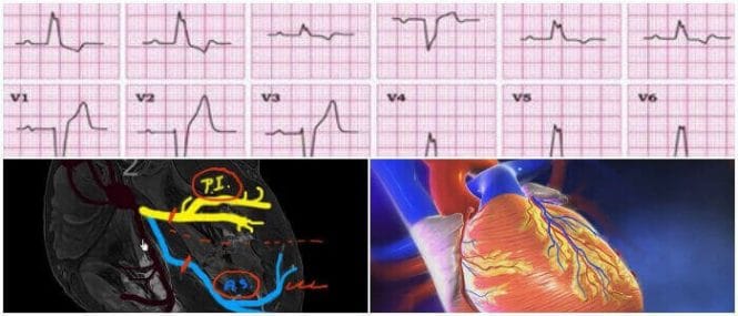 hemibloqueo anterior izquierdo en adultos