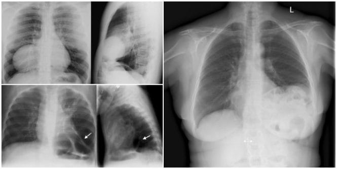 consecuencias de la hernia diafragmatica en bebes