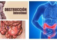 obstruccion intestinal baja