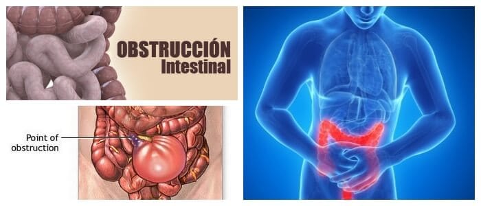 obstruccion intestinal baja