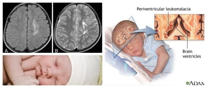 Leucomalacia Periventricular Causas Sintomas Diagnostico Tratamiento Y Prevencion Arriba Salud