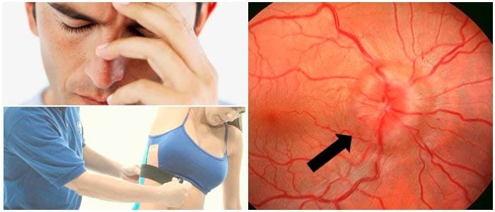 tratamiento de la neuritis