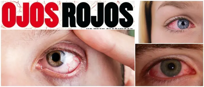 ojos rojos dolor de cabeza