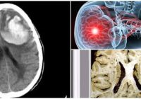 Que es la angiopatia amiloide cerebral