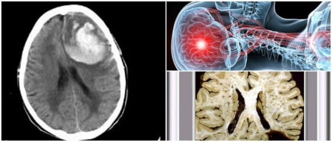 Que es la angiopatia amiloide cerebral