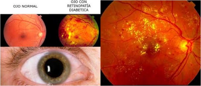 causas de la retinopatía