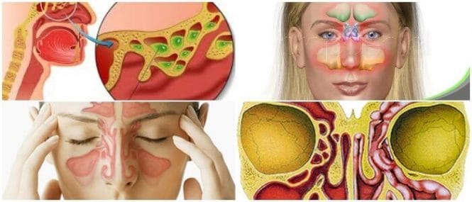 definición de rinosinusitis