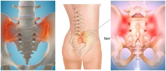 cura definitiva para la sacroileitis
