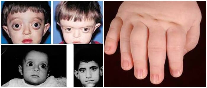 fisiopatologia del sindrome de bartter