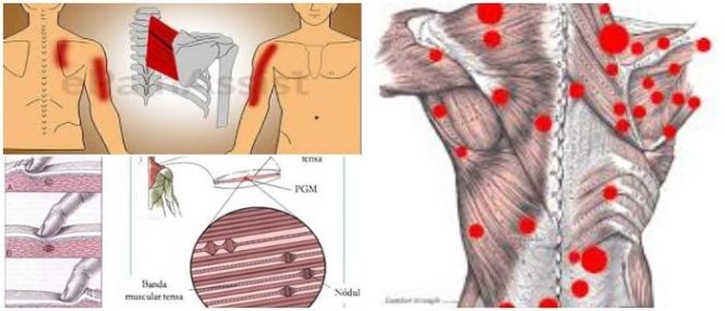 sindrome miofascial agudo