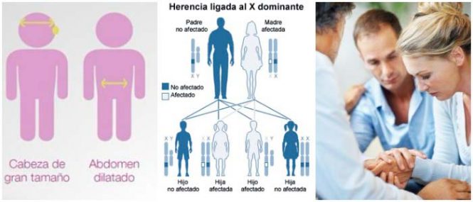 genetica y el sindrome de hunter