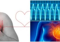 tratamiento de la taquicardia supraventricular