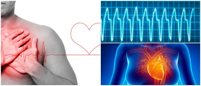 Taquicardia Ventricular O Que Sintomas E Tratamento A Sua Sa De The