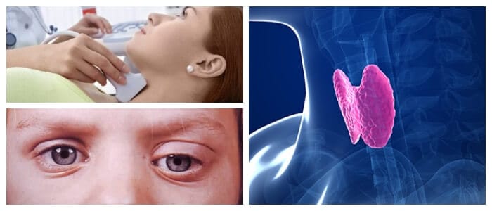 tirotoxicosis tratamiento