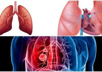 Causas y complicacioens de la tromboembolia pulmonar