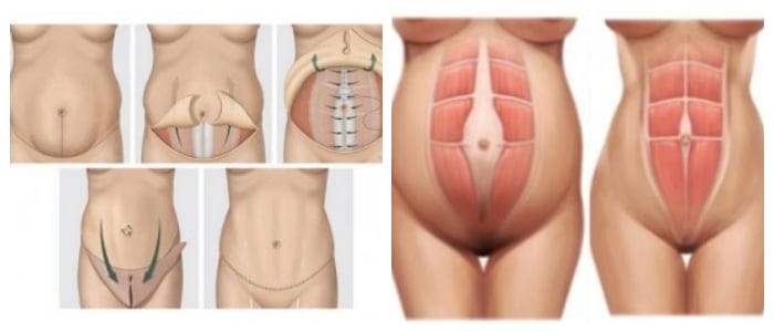 antes y después de la abdominoplastia