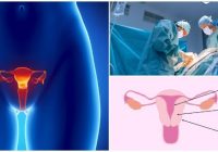 ablación endometrial por histeroscopia