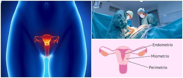 ablación endometrial por histeroscopia