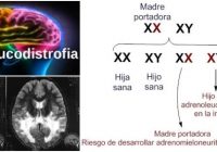 la adrenoleucodistrofia ligada al cromosoma x