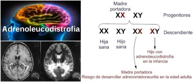 la adrenoleucodistrofia ligada al cromosoma x