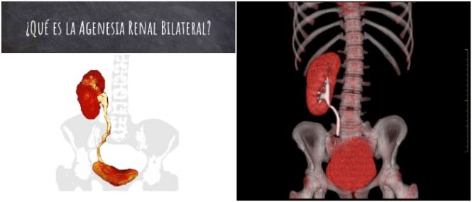 definición de la agenesia renal