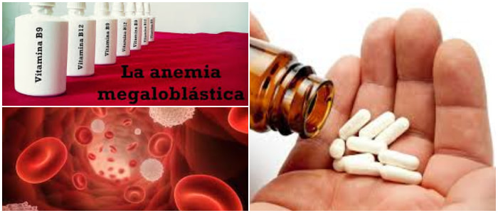 anemia megaloblástica tratamiento