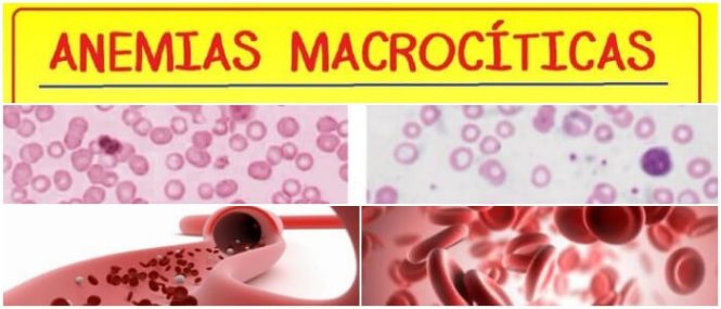 definición de la anemia microcitica