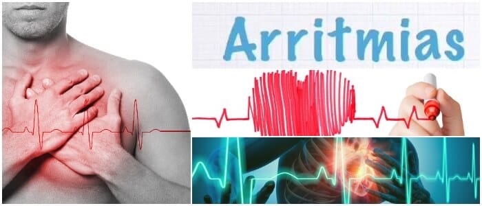 arritmia sinusal bloqueo incompleto de rama derecha