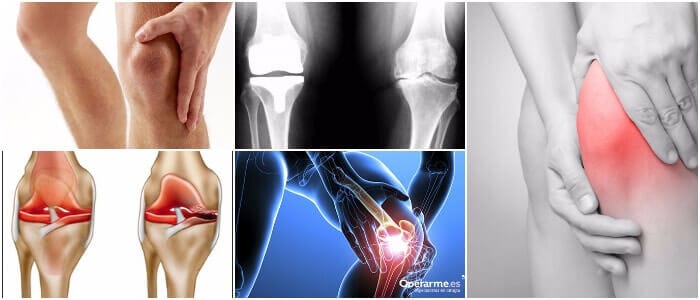 Causas de la artrosis de rodilla.