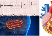 bradicardia del bloqueo auriculoventricular