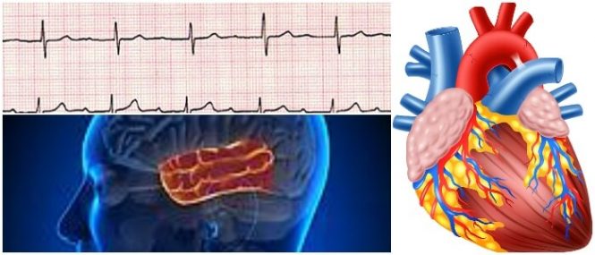 bradicardia del bloqueo auriculoventricular