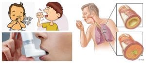 ブロンコエスパスモスの原因は何ですか? 