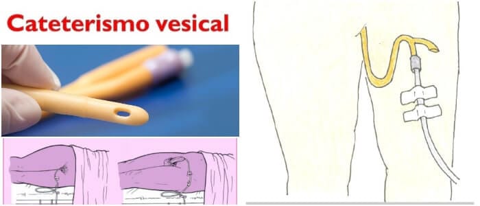 beneficios del cateterismo vesical