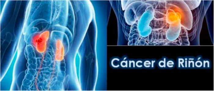 cancer de riñon en ancianos