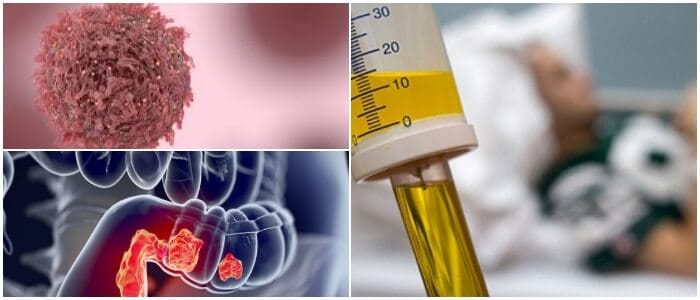 síntomas del cáncer de colon