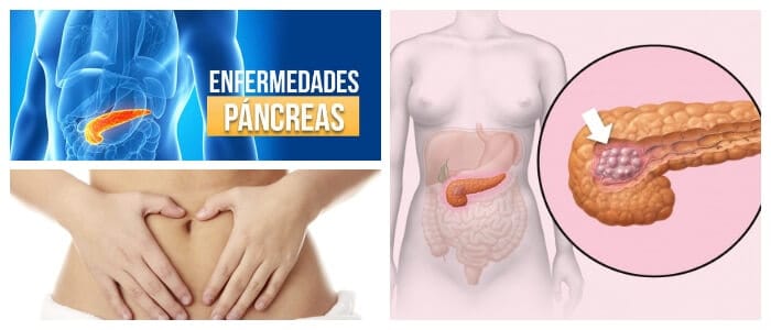 enfermedades comunes del páncreas