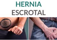hernia escrotal al nacer