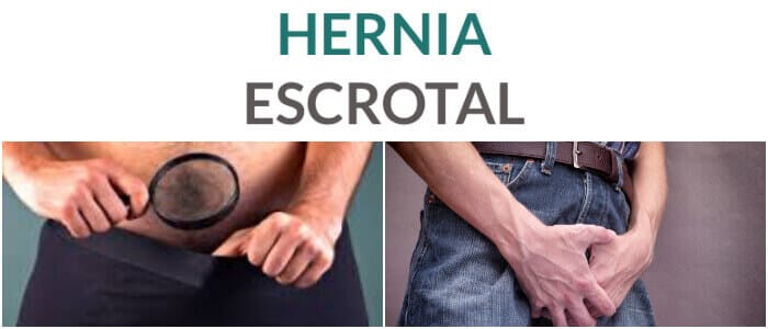 hernia escrotal al nacer