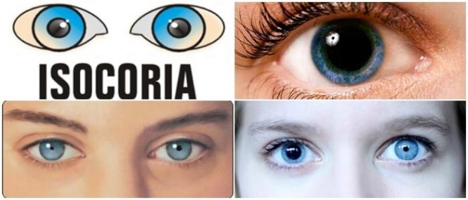 isocoria anisocoria discoria