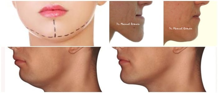 mentoplastia y acido hialuronico