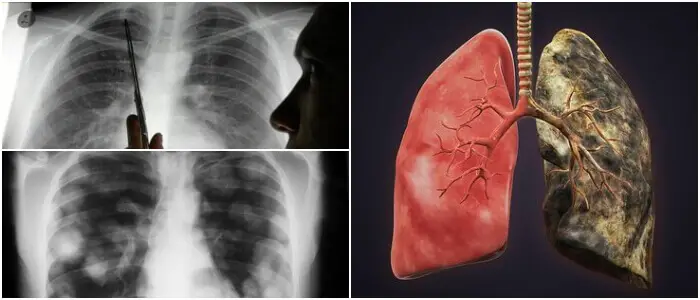 metástasis de pulmón por cáncer de mama