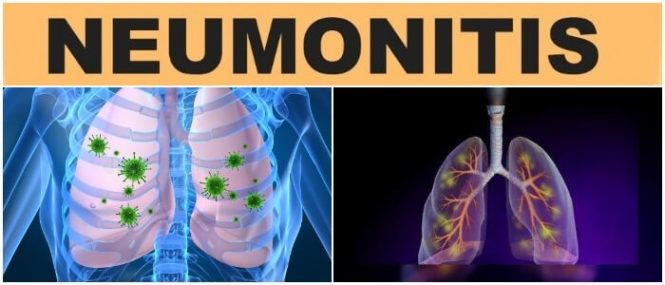 Neumon A Qu Es S Ntomas Tipos Causas Diagn Stico Y Tratamiento Arriba Salud