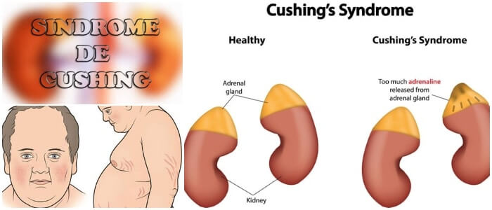 Síndrome De Cushing Causas Síntomas Diagnóstico Y Tratamiento Arriba Salud