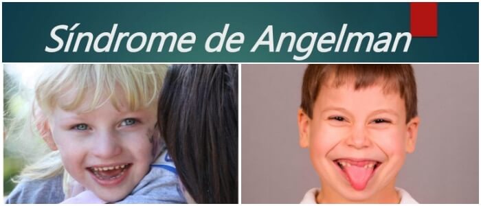 Atención Temprana En El Síndrome De Angelman. La Importancia De La